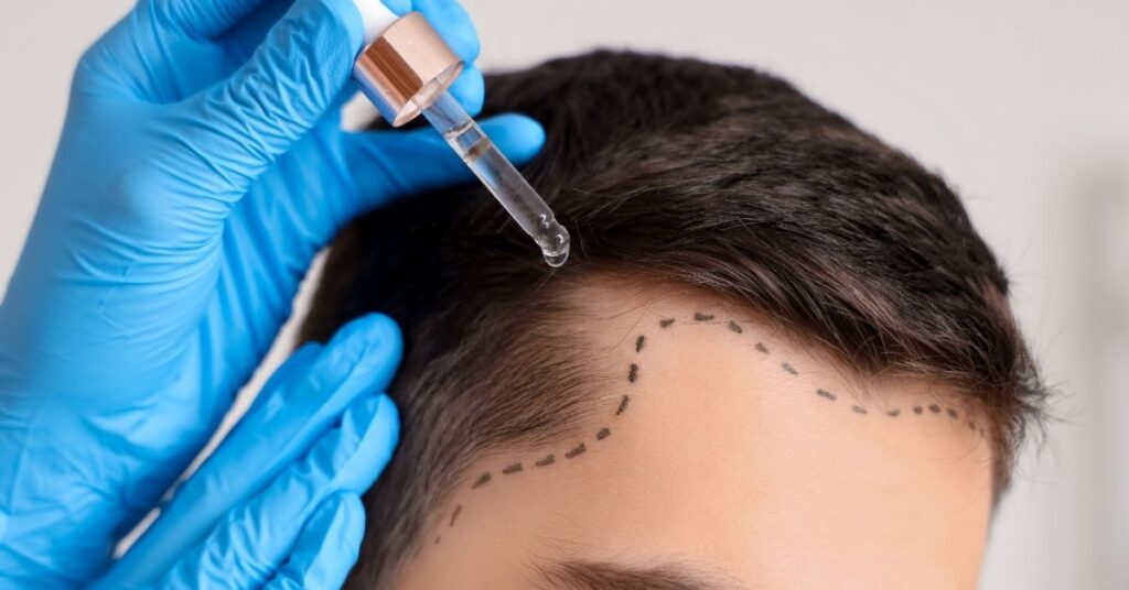 Bitkisel saç dökülmesi uygulanan yöntemlerden biri olup çözüm olur mu görmek lazım.