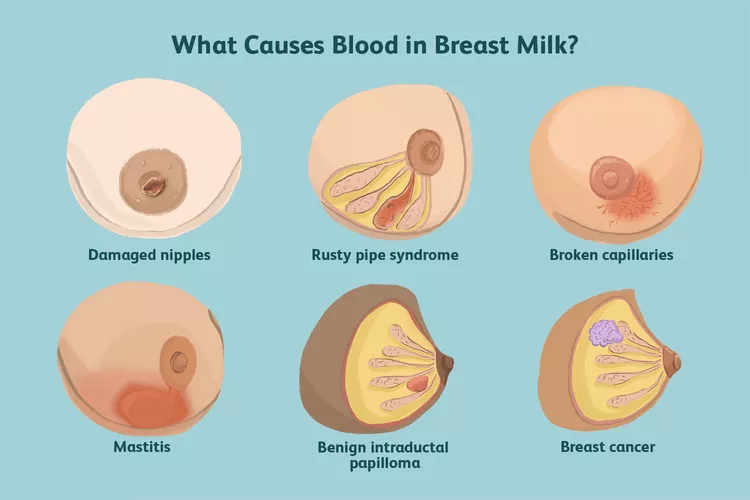 Meme başı yaraları ciddi olup tedavi edilmesi gerekir.